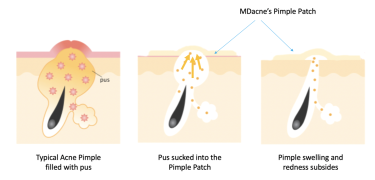 How Do Pimple Patches Work