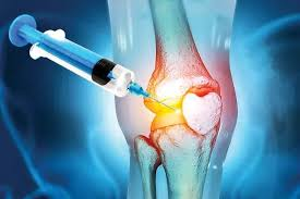 Bone Glue For Joints